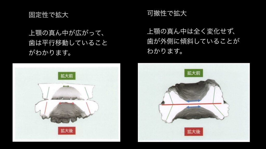 子どもの矯正上顎拡大図
