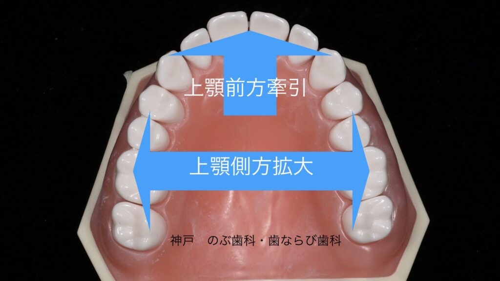 上顎を横や前後に広げるイメージ写真
