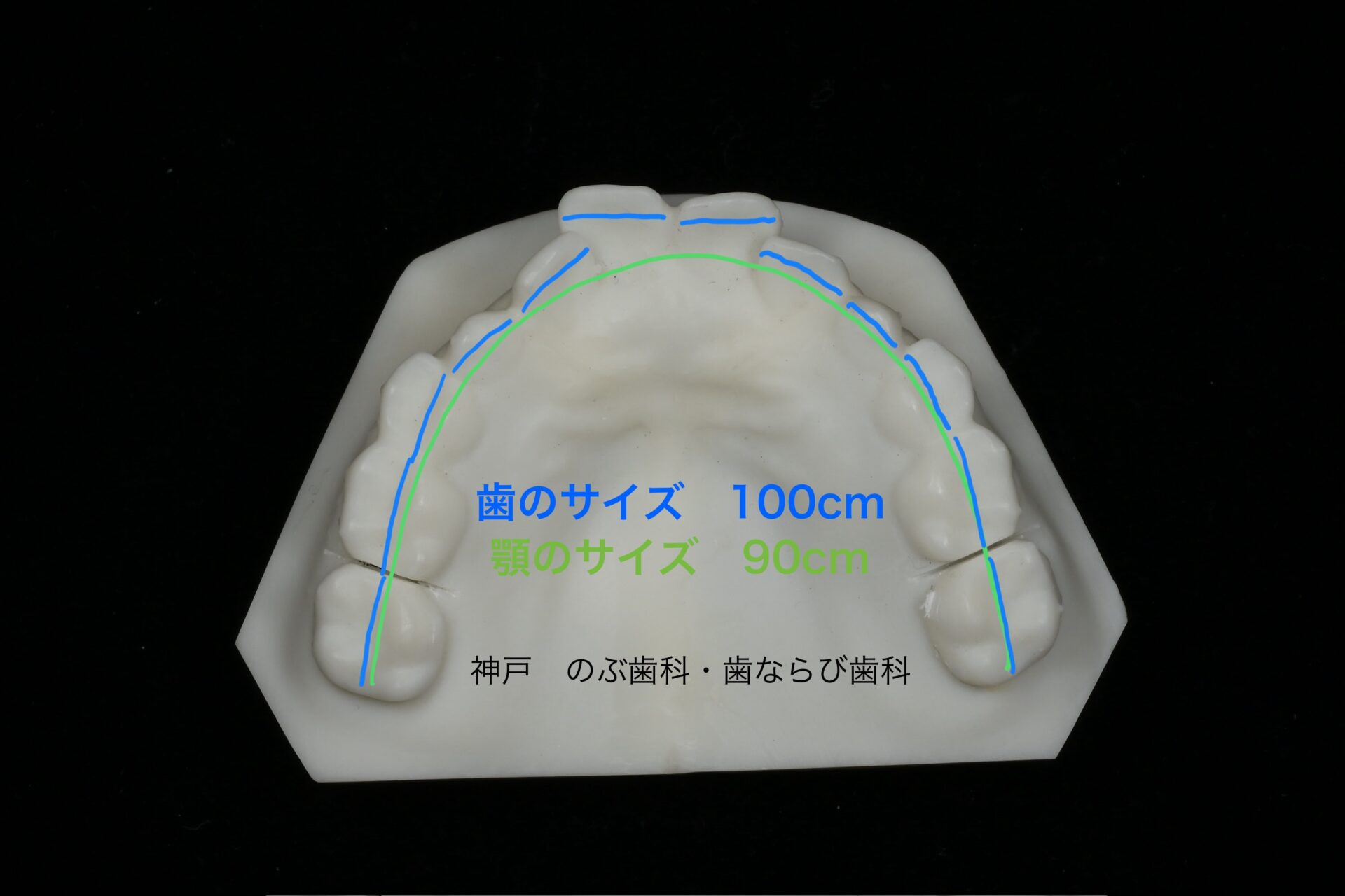 ガタガタな歯の図