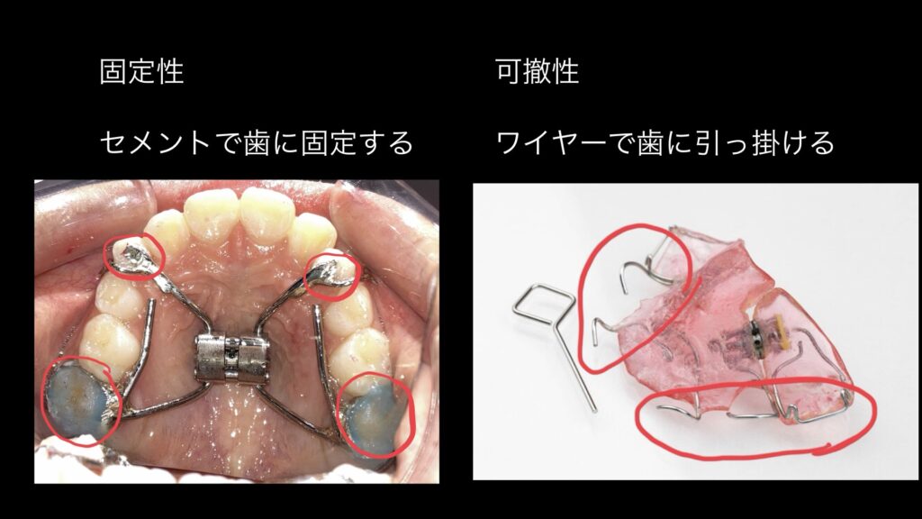 固定性の上顎拡大装置写真