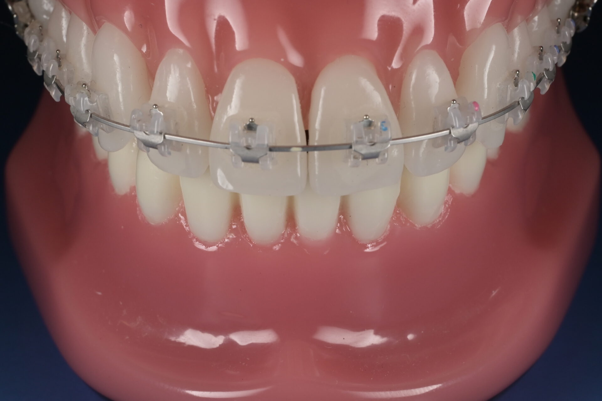 ワイヤーの矯正器具を付けた歯の模型写真
