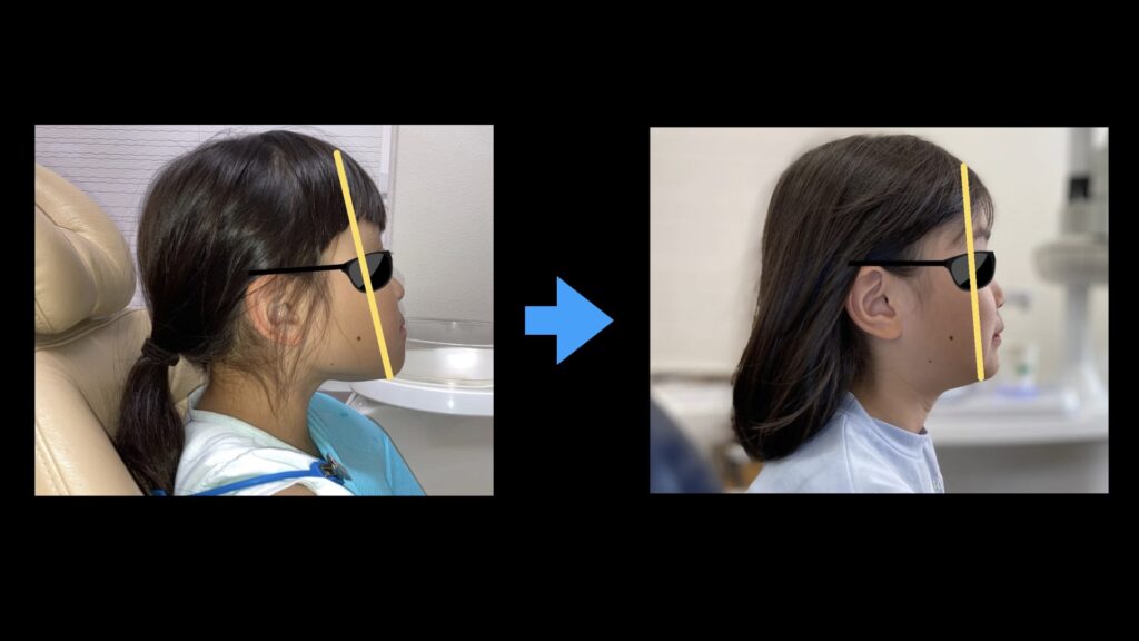 矯正前後の横顔比較写真