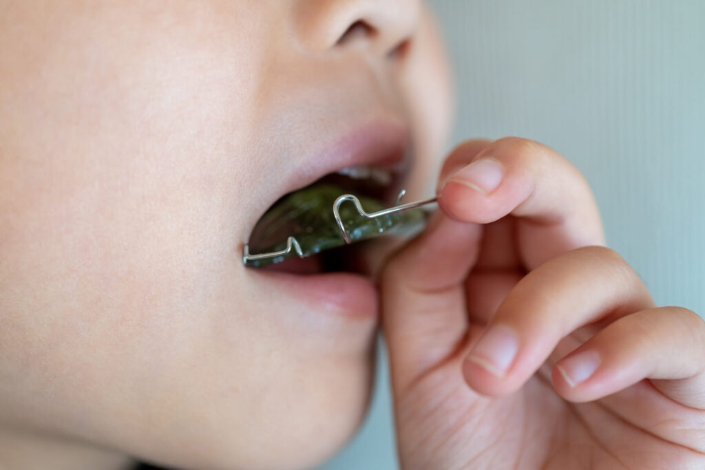 取り外し式上顎拡大装置写真