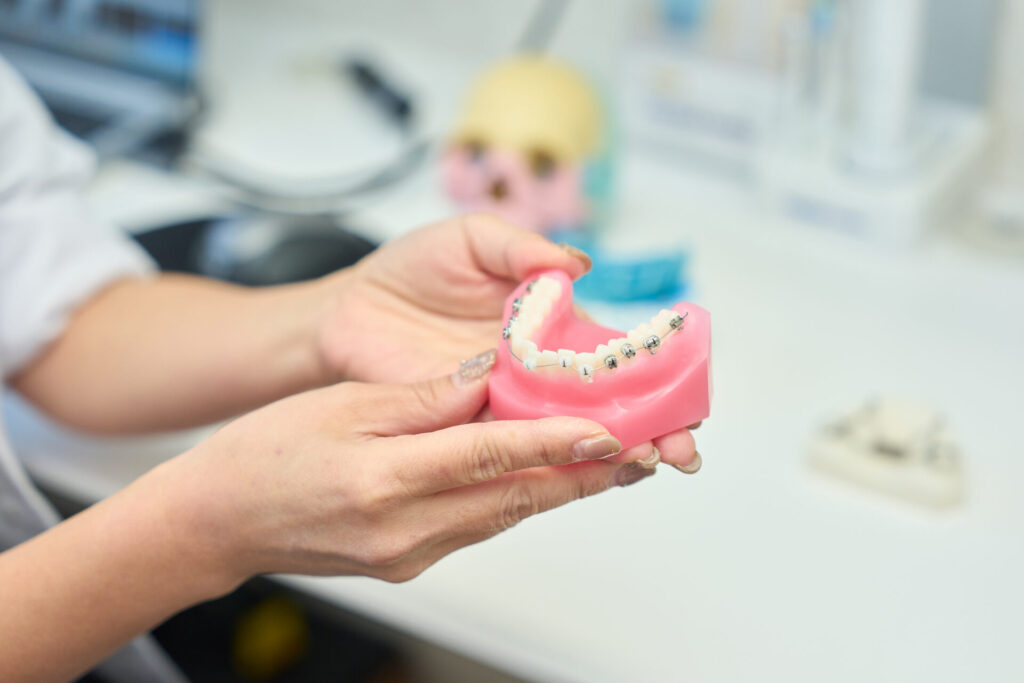 ワイヤー矯正の模型