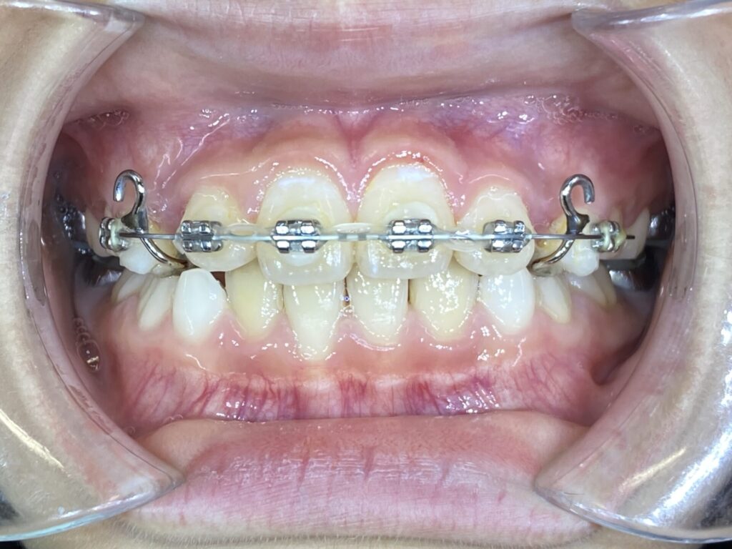 ワイヤー矯正装着