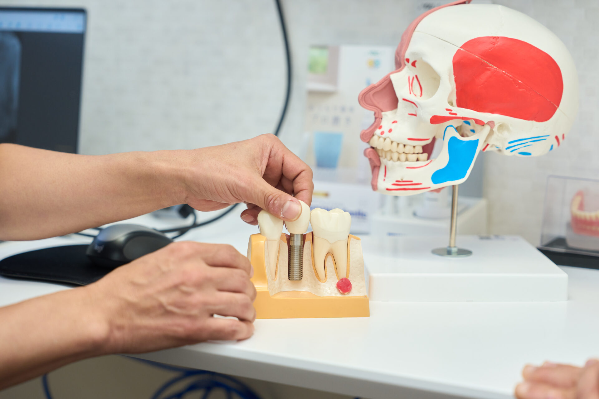 インプラント模型を使って説明