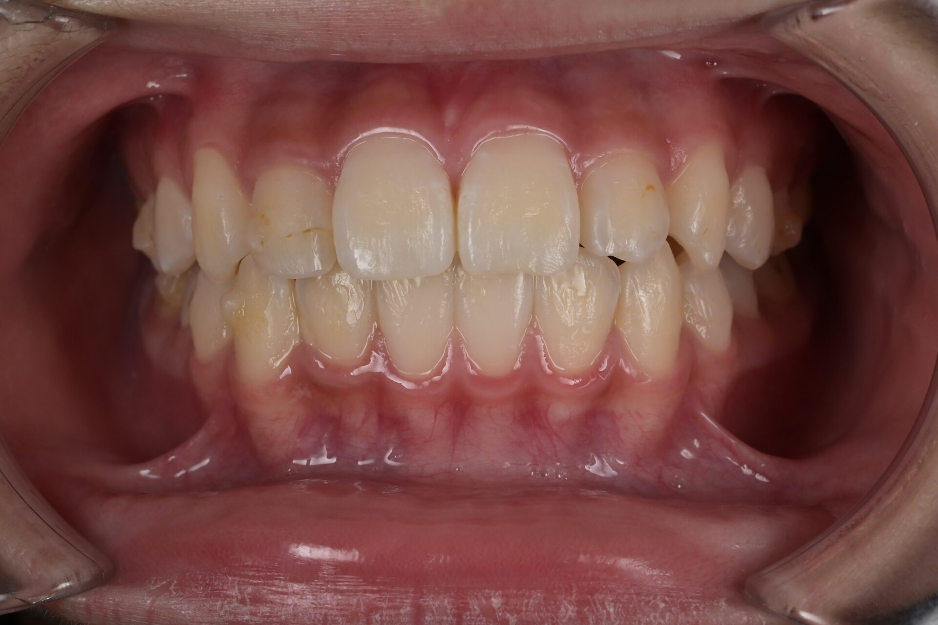 中学生の口腔内写真