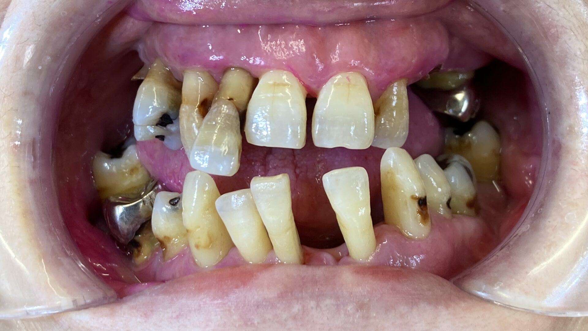 ボロボロな状態の口腔内