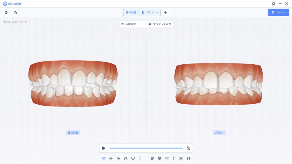 矯正のシミュレーションデータ