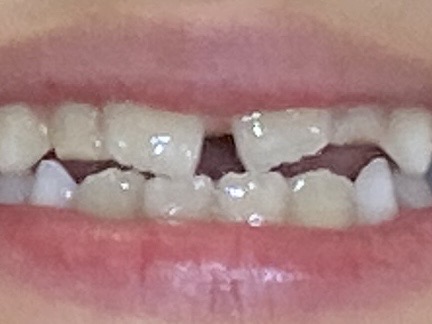 上顎前歯の隙間が大きく開いている子供の写真