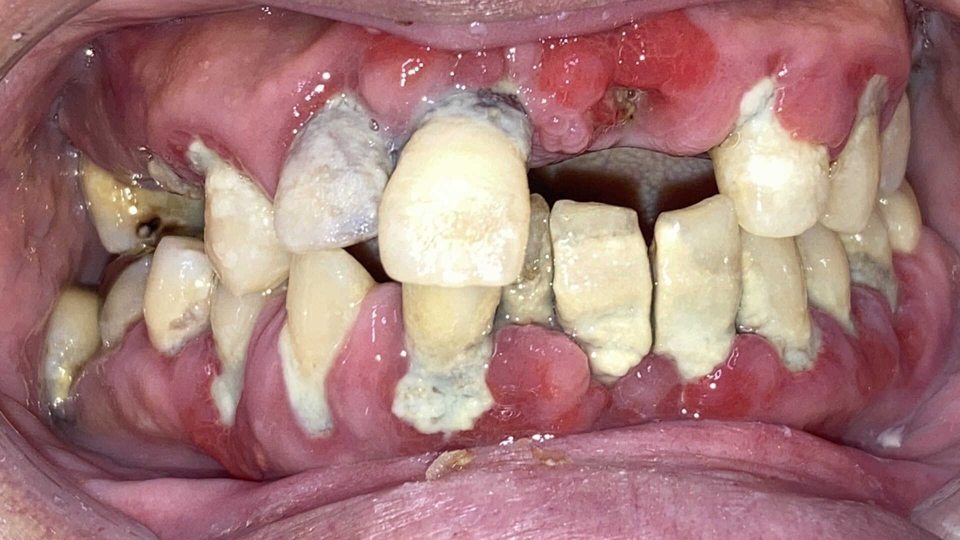 若くしてボロボロな状態の口腔写真