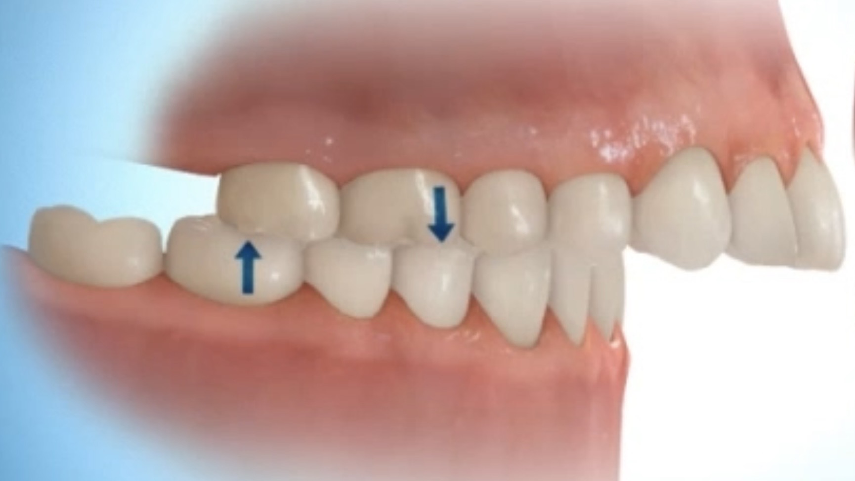 出っ歯の状態を表した画像