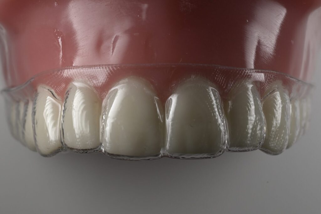 マウスピース矯正の模型写真