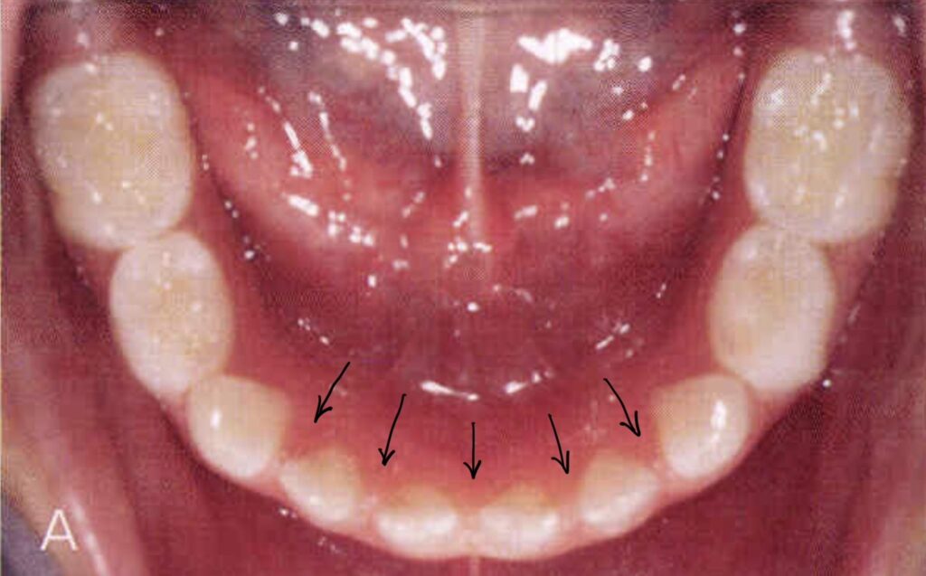 永久歯が生えるために必要なスペースを表す写真