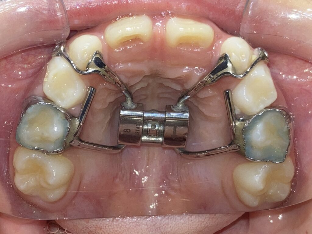 上顎拡大装置を取り付けた口腔内の写真