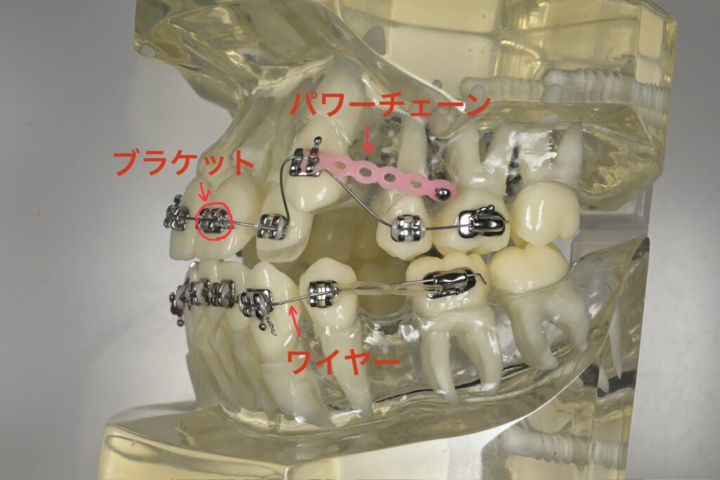 矯正器具の各名称説明