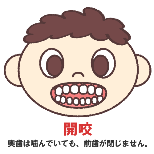 開咬を表すイラスト