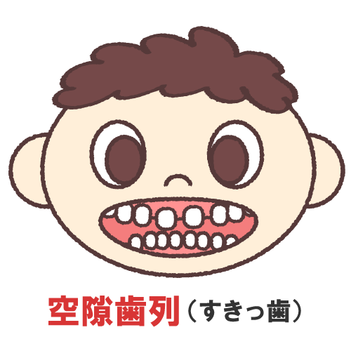 空隙歯列を表すイラスト