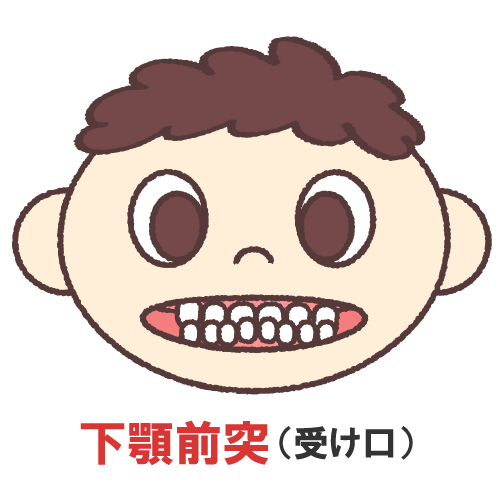 下顎前突を表すイラスト