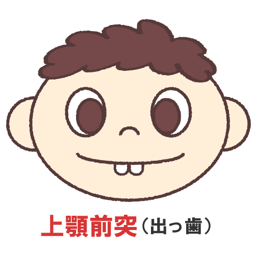 上顎前突を表すイラスト
