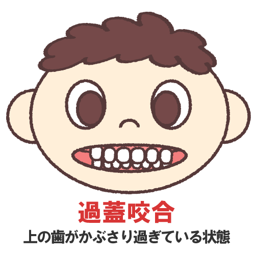 過蓋咬合を表すイラスト
